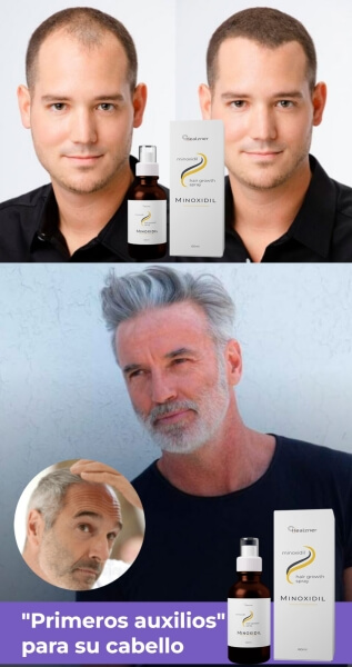 ¿Qué es el Minoxidil y para qué sirve?